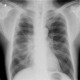 Small cell lung carcinoma, SCLC, metastasis in pancreas: X-ray - Plain radiograph